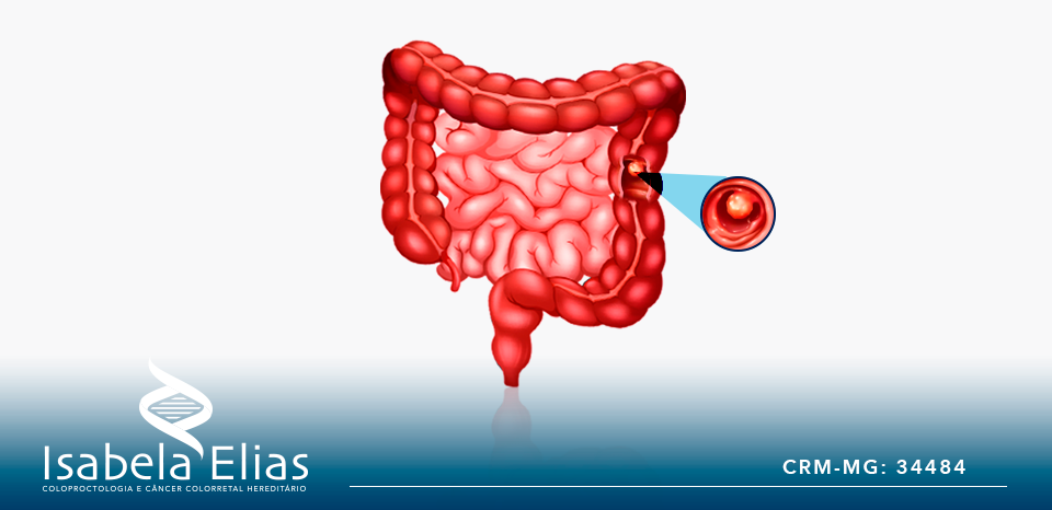 5 perguntas e respostas sobre pólipos intestinais