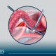 As vantagens da laparoscopia no tratamento de doenças intestinais