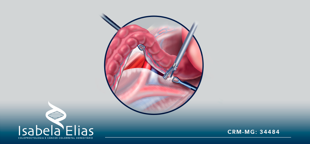 As vantagens da laparoscopia no tratamento de doenças intestinais