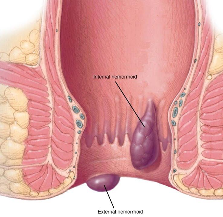 Hemorroidas